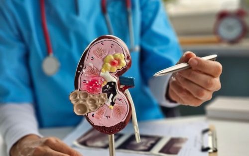 Tanpa Disadari, 5 Kebiasaan Sepele Ini Bisa Picu Batu Ginjal