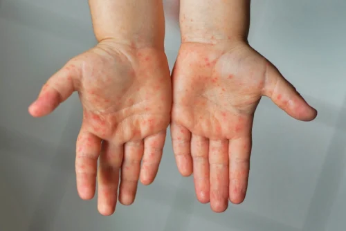 Gejala Campak Sangat Menular, Satu Orang Bisa Tulari 18 Orang