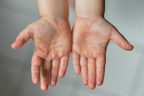 Sekilas Serupa, Kenali 3 Perbedaan Campak dan Cacar Air