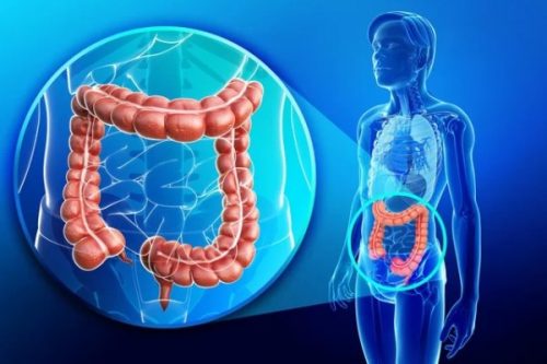 kopi kesehatan kanker usus