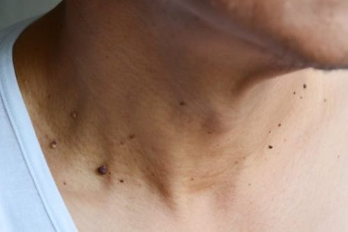 kelainan kulit kanker