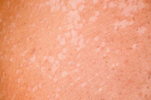 bercak di kulit