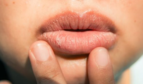 bibir pecah pecah