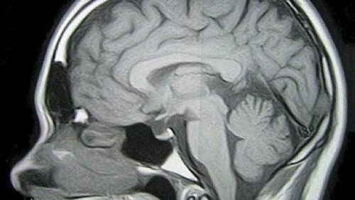 pengecilan jaringan cortex