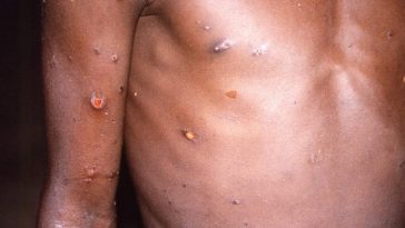 Cacar Monyet (Monkeypox) Muncul Pada 1970, Ini Negara yang Pernah Terinfeksi
