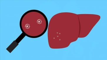 Indonesia Catat 18 Kasus Dugaan Hepatitis Akut, 7 Pasien Meninggal