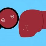 Dugaan Hepatitis Akut Bertambah 14 Kasus