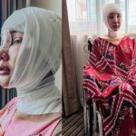 Lucinta Luna Operasi Potong Leher Hilangkan Jakun, Bagaimana Prosedurnya?