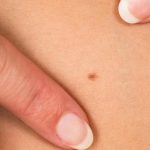 Bisakah Tahi Lalat Jadi Pertanda Kanker Payudara? Ini Penjelasannya!