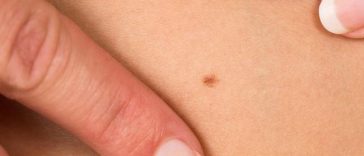 Bisakah Tahi Lalat Jadi Pertanda Kanker Payudara? Ini Penjelasannya!