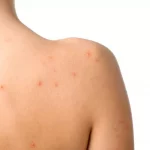 Cara Atasi Jerawat 'Bandel' yang Muncul di Punggung