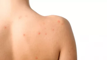 Cara Atasi Jerawat 'Bandel' yang Muncul di Punggung