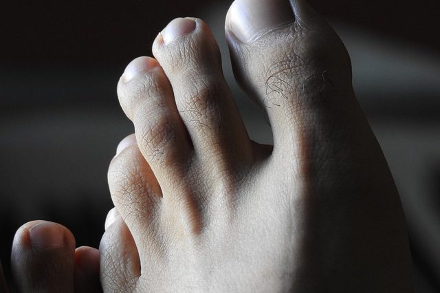 Ini Gejala Pertama yang Terasa Saat Kolesterol Menyumbat Arteri