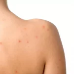 Tiga Cara Atasi Jerawat yang Muncul di Tubuh