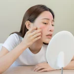 Delapan Cara Hilangkan Bekas Jerawat Hitam Secara Alami