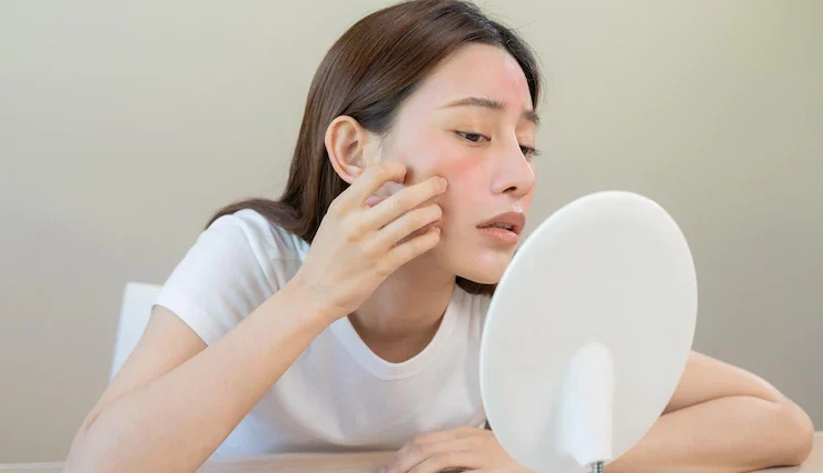 Delapan Cara Hilangkan Bekas Jerawat Hitam Secara Alami