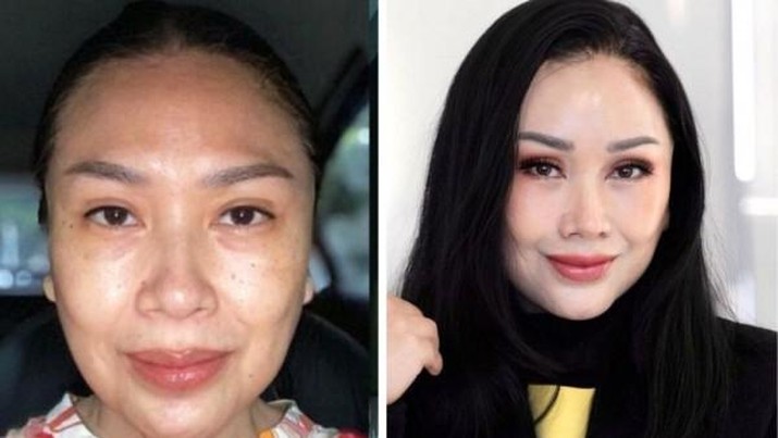 Mau Operasi Anti Aging seperti Titi DJ? Segini Biayanya!