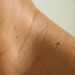 Skin Tag Bisa Mengganggu Penampilan, Berikut Cara Menghilangkannya