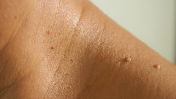 Skin Tag Bisa Mengganggu Penampilan, Berikut Cara Menghilangkannya