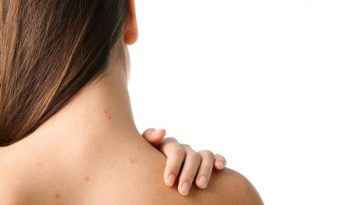 Lima Cara Atasi Jerawat di Punggung, Salah Satunya Pakai Seprai Bersih