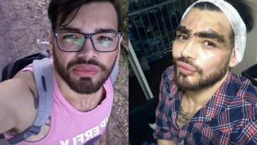 Terobsesi Mirip Ricky Martin, Pria Ini Nekat Suntikkan Oli Motor ke Wajahnya