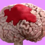 Kenali Penyebab Pendarahan Otak Seperti yang Dialami Cak Nun