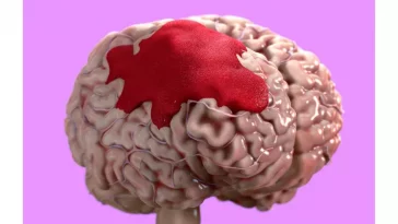 Kenali Penyebab Pendarahan Otak Seperti yang Dialami Cak Nun