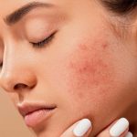 Bopeng Bekas Jerawat Bisa Hilang dengan Chemical Peeling?