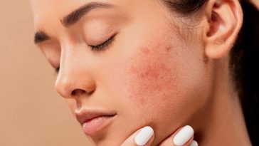 Bopeng Bekas Jerawat Bisa Hilang dengan Chemical Peeling?