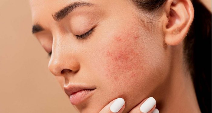 Bopeng Bekas Jerawat Bisa Hilang dengan Chemical Peeling?