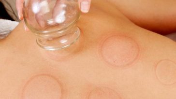 6 Manfaat Bekam yang Baik untuk Kesehatan Tubuh, Bisa Membuang Racun