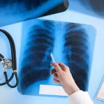 Mencegah Radang Paru-Paru, Berikut 7 Panduan untuk Kesehatan Pernapasan