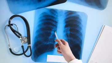 Mencegah Radang Paru-Paru, Berikut 7 Panduan untuk Kesehatan Pernapasan