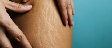 Minyak Jarak Bisa Obati Stretch Mark? Ini Faktanya