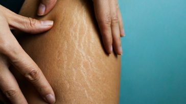 Minyak Jarak Bisa Obati Stretch Mark? Ini Faktanya
