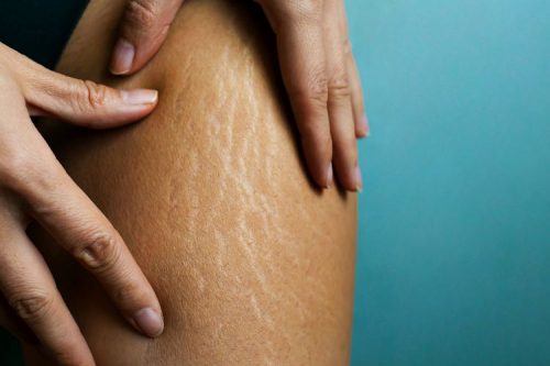 Minyak Jarak Bisa Obati Stretch Mark? Ini Faktanya