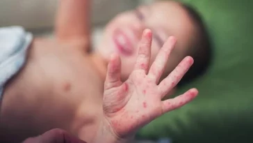 Kasus Flu Singapura Meningkat, Jangan Sampai Menggangu Mudik Lebaran