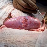 Pria Penerima Ginjal Babi Pertama di Dunia Akhirnya Meninggal