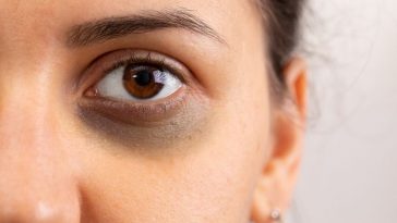 Jangan Remehkan Lingkaran Hitam di Bawah Mata, Bisa jadi Indikasi Penyakit