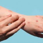 Ketahui Gejala dan Penyebab Mpox atau Cacar Monyet, Apa Saja?