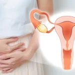 Hindari 5 Makanan Ini untuk Cegah Risiko Kista Ovarium