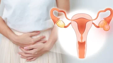 Hindari 5 Makanan Ini untuk Cegah Risiko Kista Ovarium