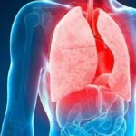 5 Fakta Kasus TBC di Indonesia yang Jadi Peringkat Ke-2 Terbanyak di Dunia