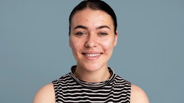 Jangan Memencet Jerawat di Area Hidung, Ini 5 Alasannya!