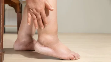 Jangan Disepelekan, Kaki Bengkak Bisa Jadi Tanda 5 Penyakit Ini