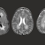 Mengenal Penyakit Gangguan Genetik MLD yang Harga Obatnya Rp70,5 M