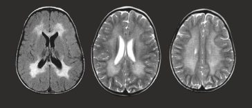 Mengenal Penyakit Gangguan Genetik MLD yang Harga Obatnya Rp70,5 M