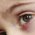 Mudah Dilakukan, Ini 5 Cara Hilangkan Bintitan di Mata