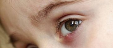 Mudah Dilakukan, Ini 5 Cara Hilangkan Bintitan di Mata