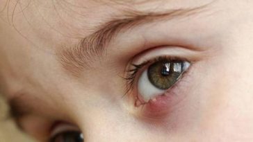 Mudah Dilakukan, Ini 5 Cara Hilangkan Bintitan di Mata